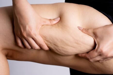 セルライト潰しは効果ある？デメリットや正しいアプローチ方法を解説