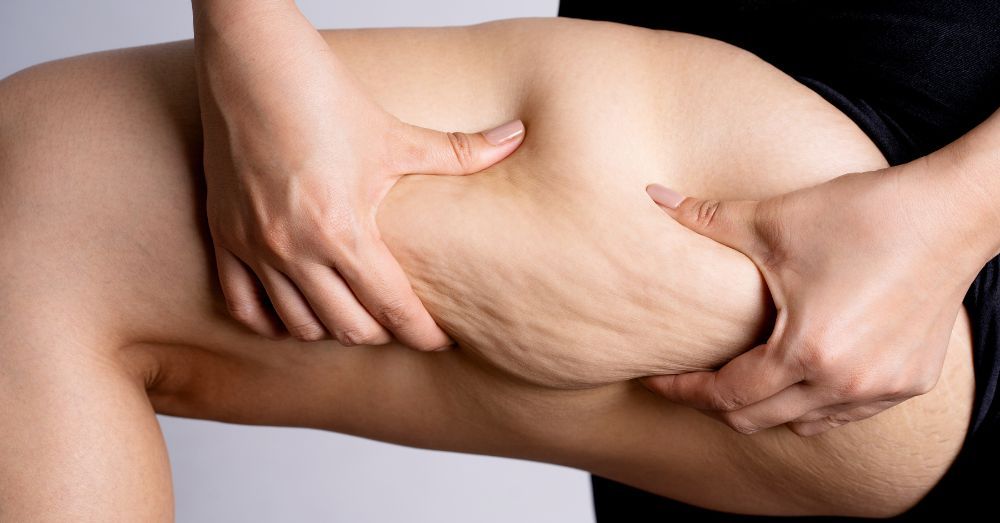 セルライト潰しは効果ある？デメリットや正しいアプローチ方法を解説