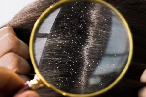 女性のフケ対策は？フケやかゆみの原因と頭皮ケアのポイント