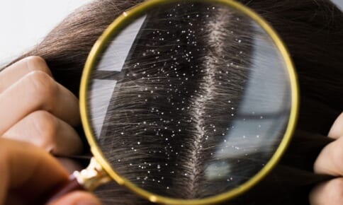 女性のフケ対策は？フケやかゆみの原因と頭皮ケアのポイント