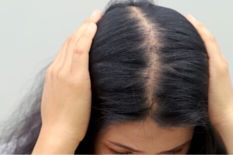 女性の分け目の薄毛の原因は？主な理由や対策を解説