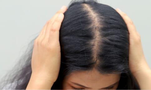 女性の分け目の薄毛の原因は？主な理由や対策を解説