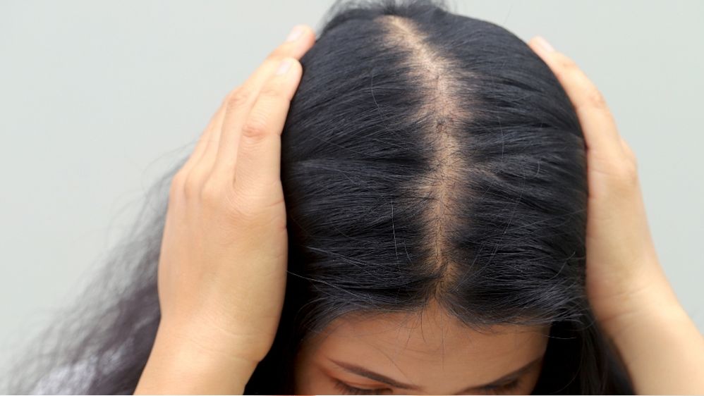 女性の分け目の薄毛の原因は？主な理由や対策を解説