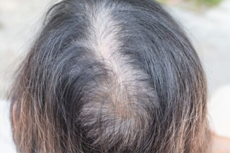 つむじが薄いと感じる女性の対策！おすすめのクリニックも紹介