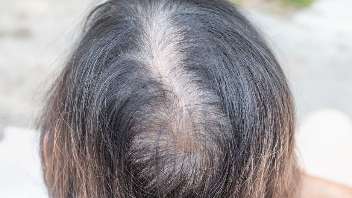 つむじが薄いと感じる女性の対策！おすすめのクリニックも紹介